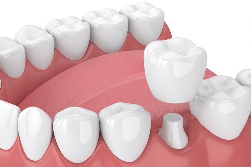 Dental Crowns in Mesquite