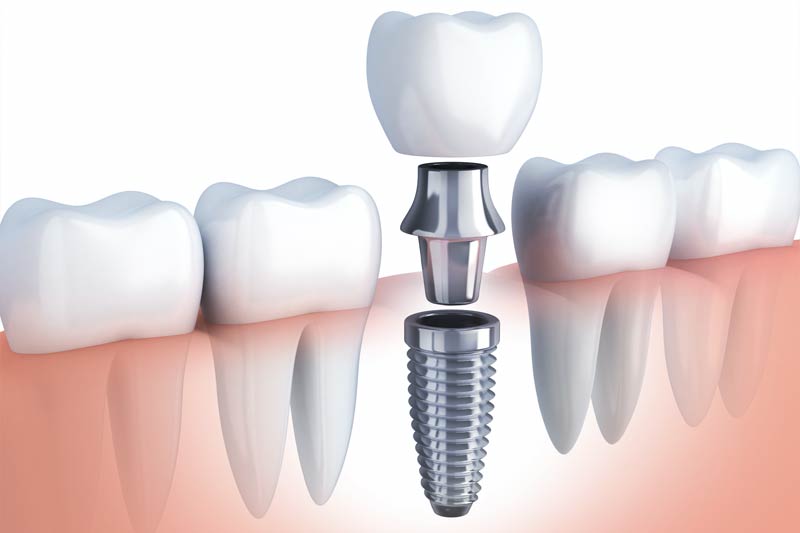 Implants Dentist in Mesquite