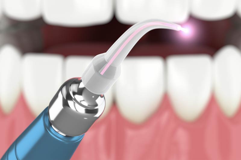 Laser Dentistry in Mesquite