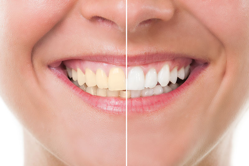 Teeth Whitening in Mesquite
