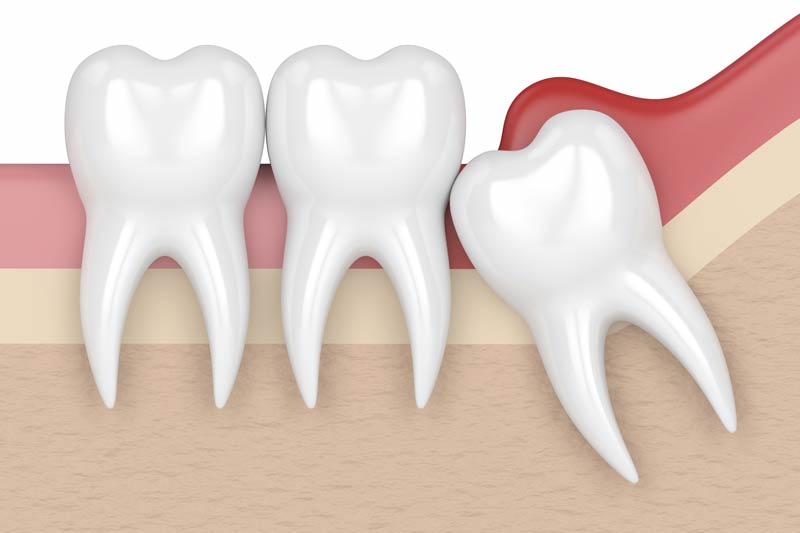 Wisdom Tooth Removal in Mesquite
